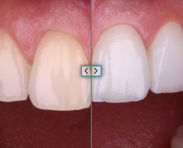 безметалеві коронки